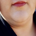 Neck Lift