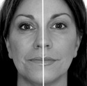 Restylane & Juvederm