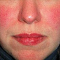 Vasculight (Laser Treatment Facial Veins)