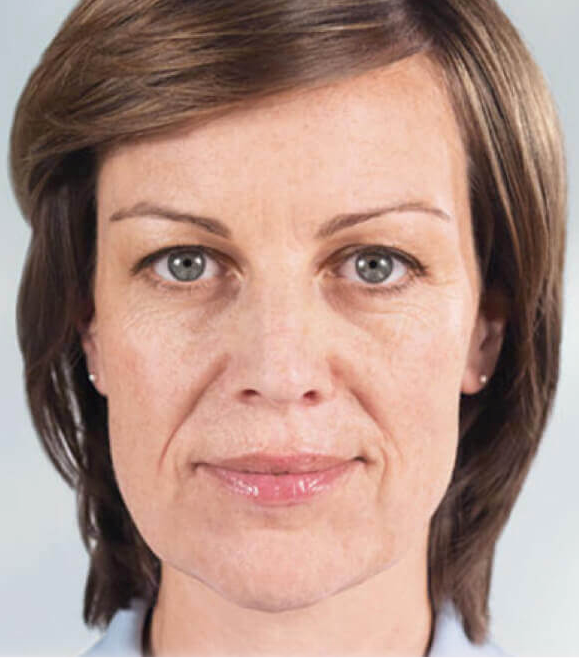Image before sculptra