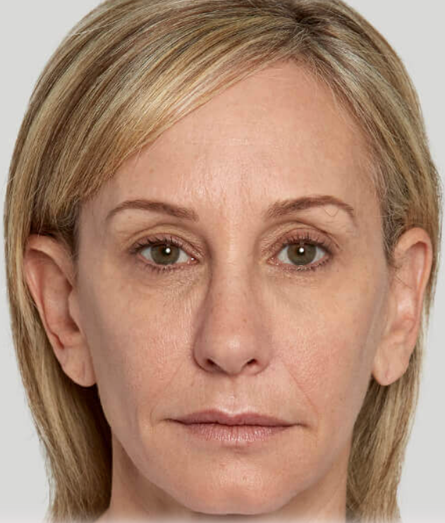 Image after sculptra