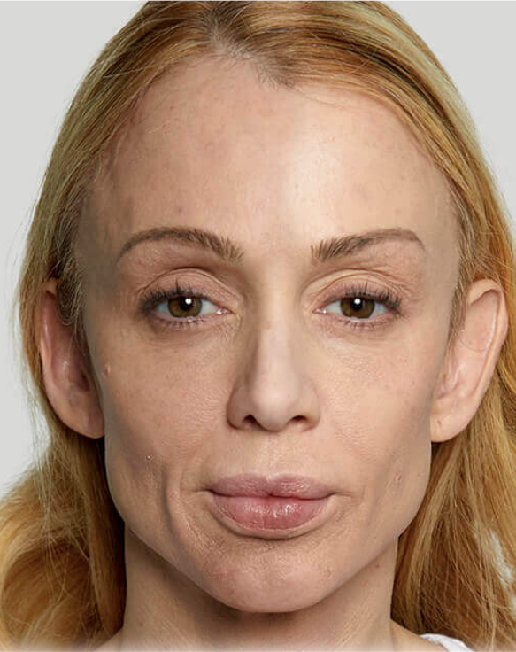 Image before sculptra