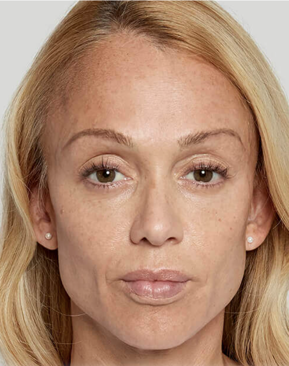 Image after sculptra