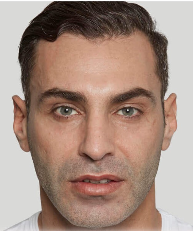 Image before sculptra