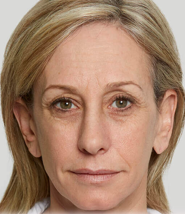 Image before sculptra