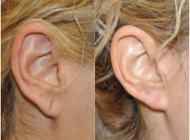 Earlobe rejuvenation before after