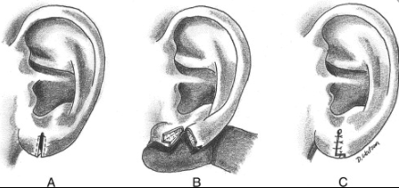 Earlobe rejuvenation diagram