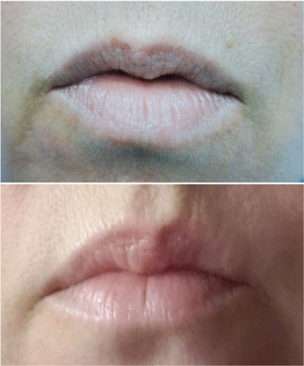 Lip Flip before and after