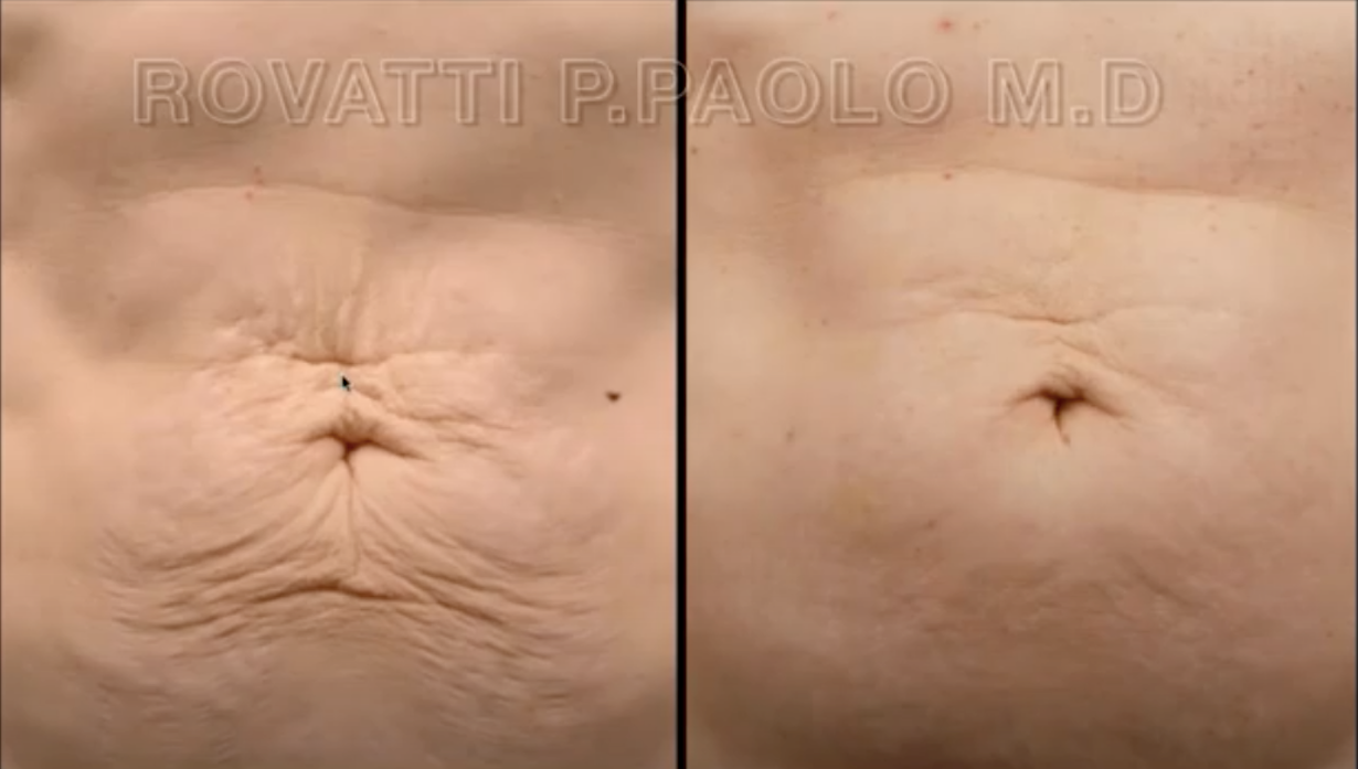 Morpheus8 before and after image
