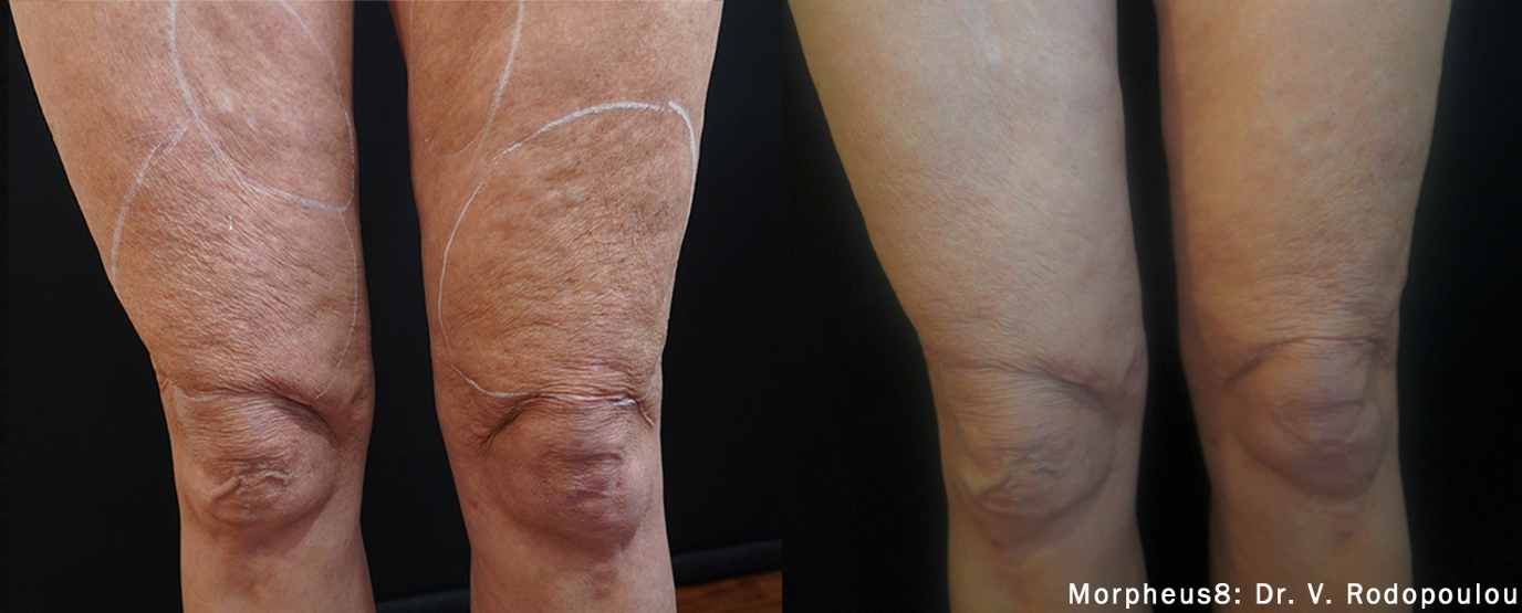 Morpheus8 before and after image
