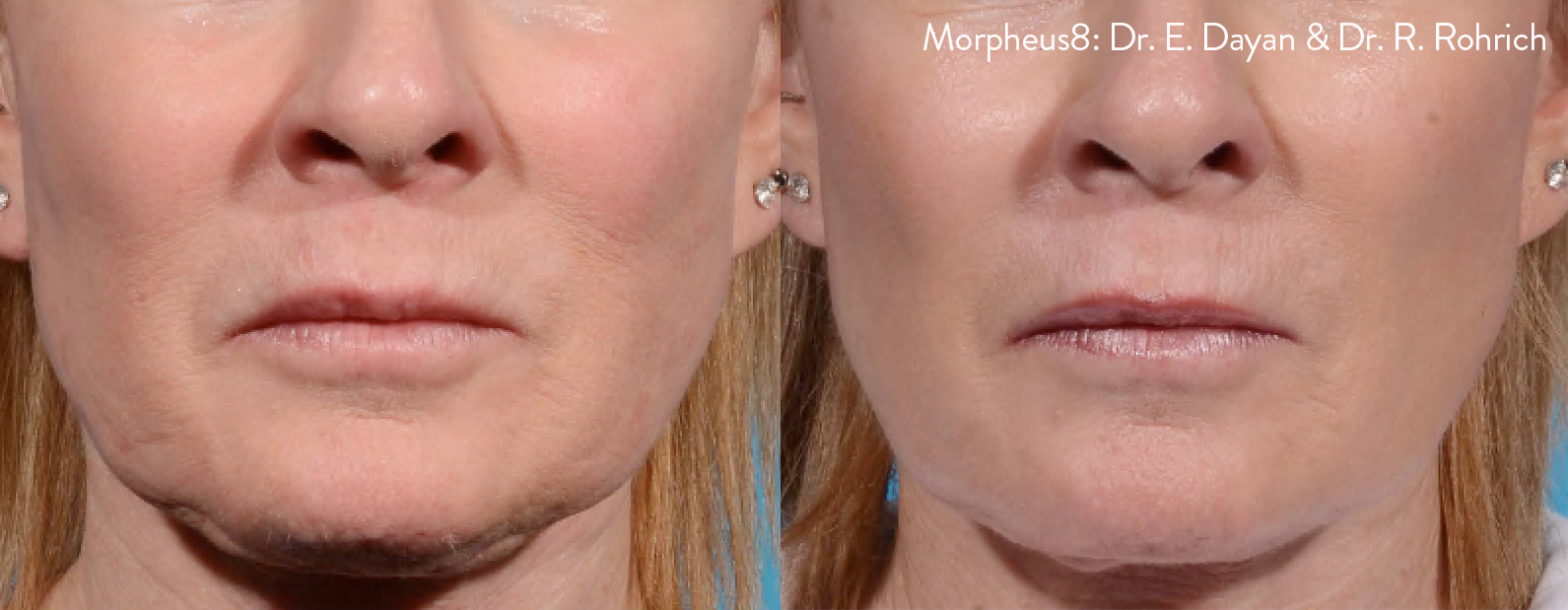 Morpheus8 before and after image