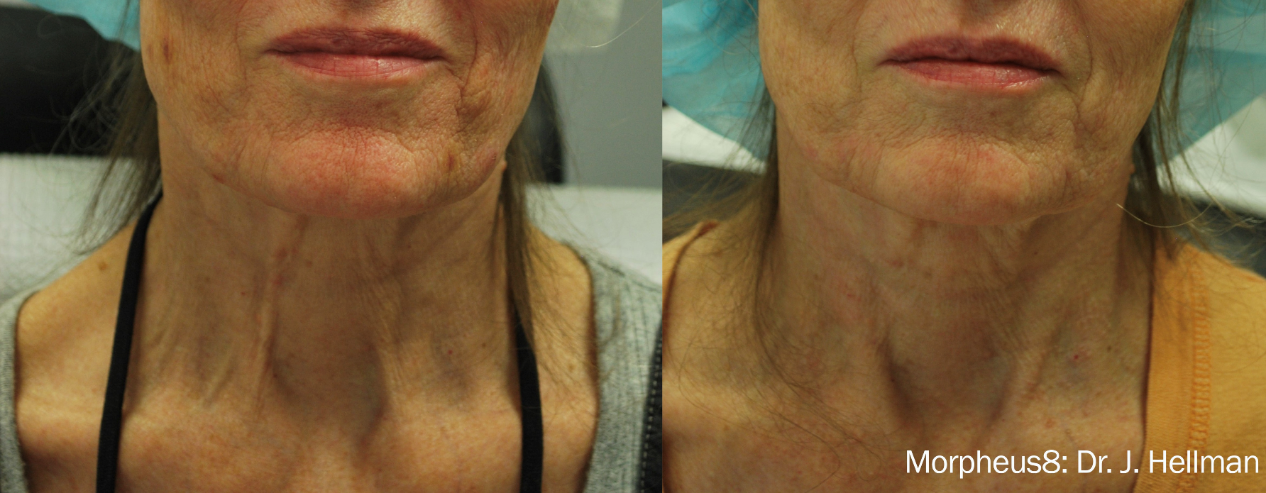 Morpheus8 before and after image