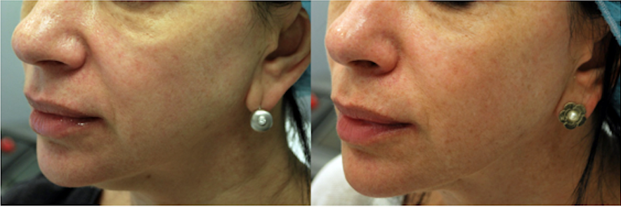 Morpheus8 before and after image