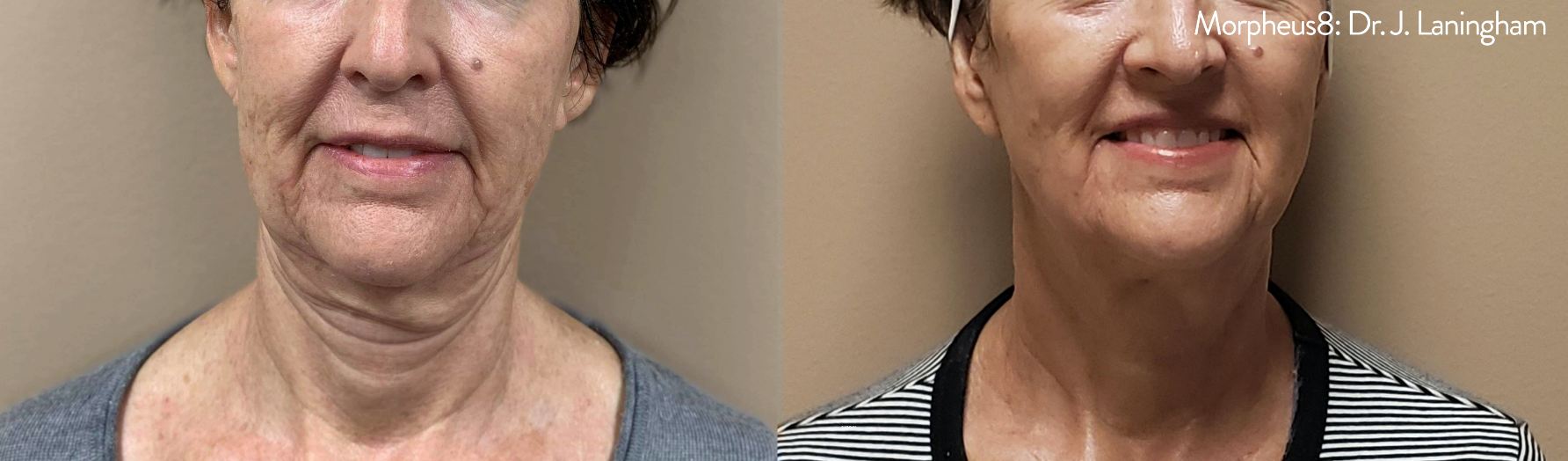 Morpheus8 before and after image