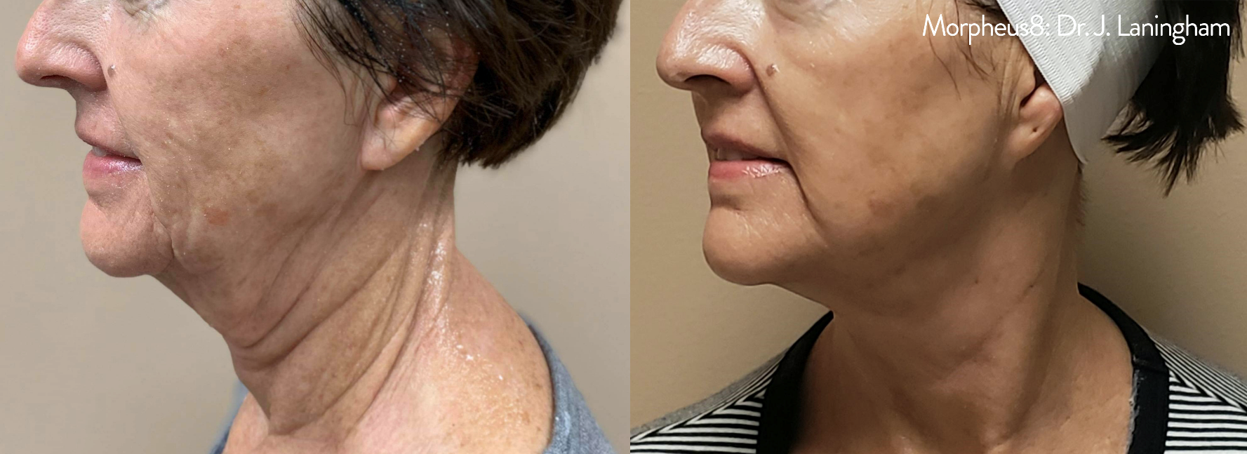 Morpheus8 before and after image