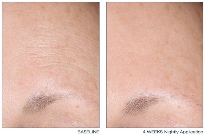 Skinbetter science before and after 4 weeks nightly application image