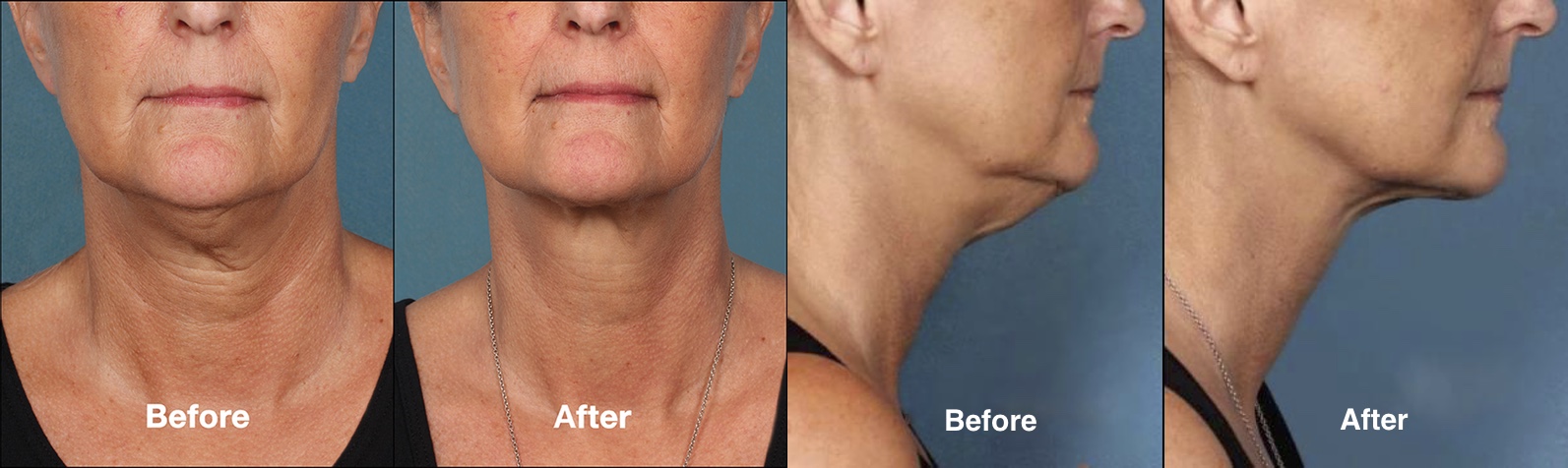 Belkyra, before and after